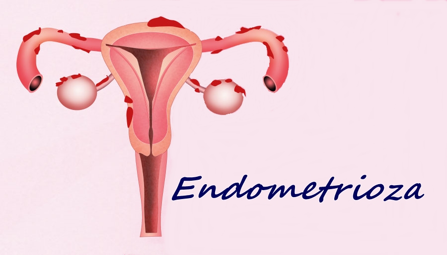 Endometrioza – choroba, której nie widać